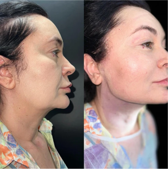 antes-depois-julio-1