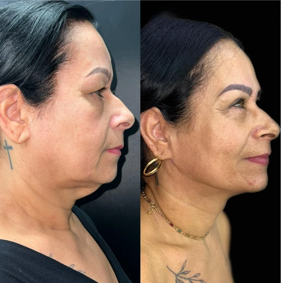 antes-depois-julio-10