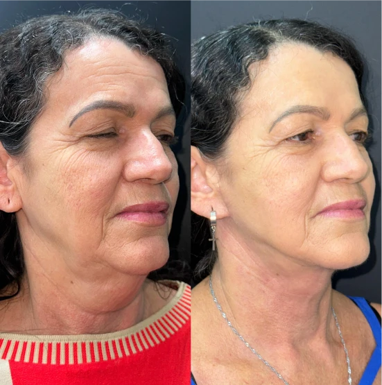antes-depois-julio-11